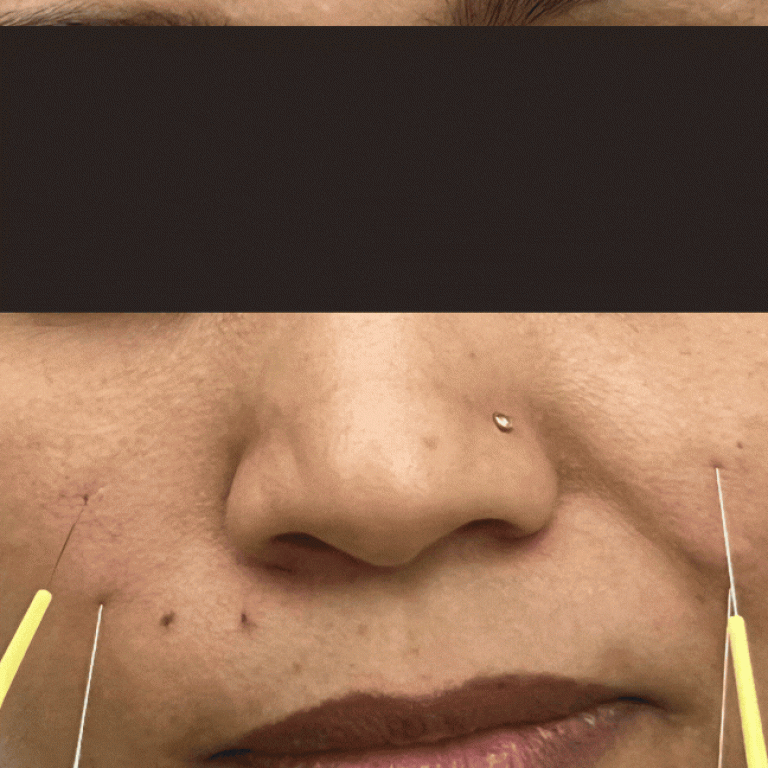 accupuncture