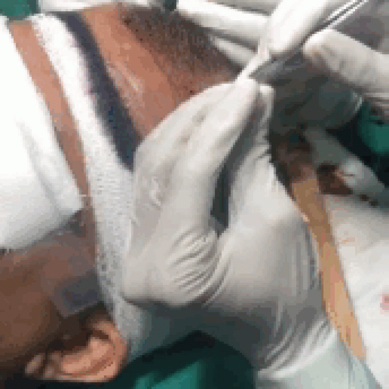 hairTransplant