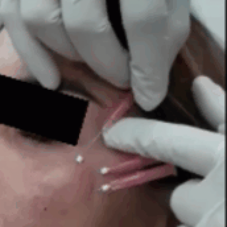 threadlift
